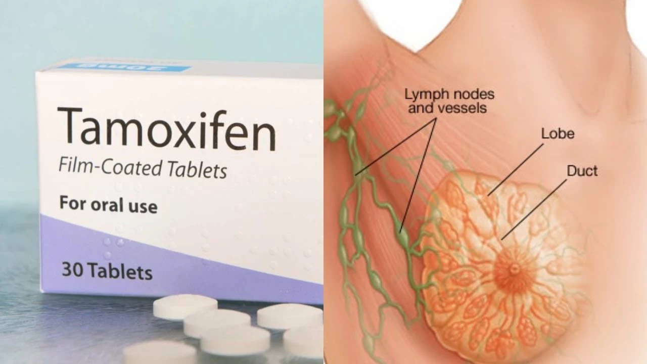Anastrozole vs. Tamoxifen: Which is Better for Breast Cancer Patients?