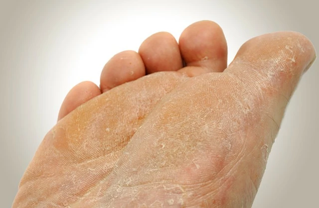 Athlete's Foot and Skin Allergies: How to Tell the Difference